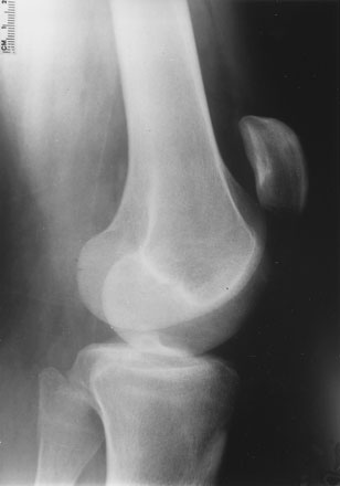 patellar tendon rupture1.jpg